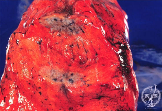 非小細胞肺癌（腺癌）マクロ像（未固定新鮮割面像）