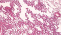 非小細胞肺癌（腺癌）ミクロ像（HE弱拡大）
