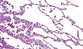 非小細胞肺癌（腺癌）ミクロ像（HE強拡大）