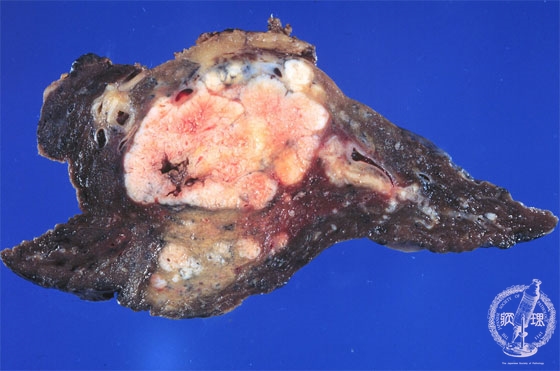 非小細胞肺癌（大細胞癌）マクロ像