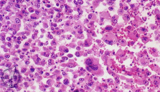 非小細胞肺癌（大細胞癌）ミクロ像（HE中拡大）