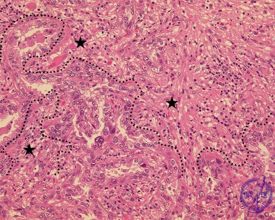 �񏬍זE�x���i�B���j�~�N�����iHE���g��j