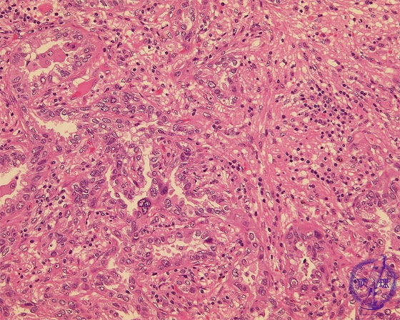 �񏬍זE�x���i�B���j�~�N�����iHE���g��j