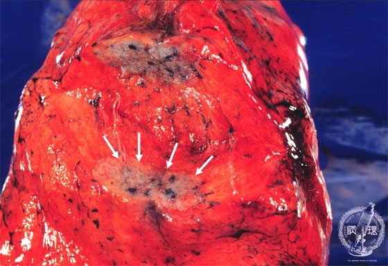 �񏬍זE�x���i�B���j�}�N�����i���Œ�V�N���ʑ��j