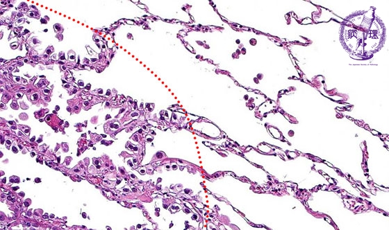 �񏬍זE�x���i�B���j�~�N�����iHE���g��j