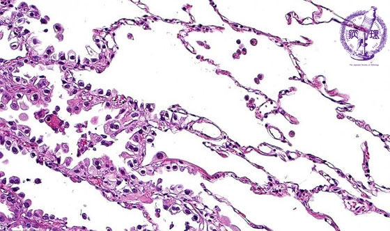 �񏬍זE�x���i�B���j�~�N�����iHE���g��j