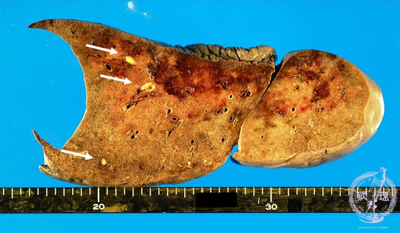 転移性肺腫瘍マクロ像