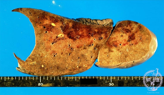 転移性肺腫瘍マクロ像