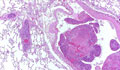 転移性肺腫瘍ミクロ像（HE弱拡大）