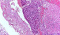転移性肺腫瘍ミクロ像（HE中拡大）