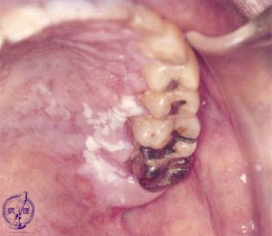 口腔粘膜疾患（白板症）マクロ像