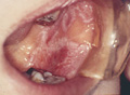 口腔粘膜疾患（扁平苔癬）マクロ像