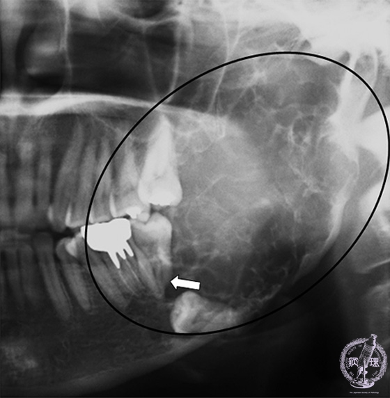 歯原性腫瘍（エナメル上皮腫）パノラマＸ線像
