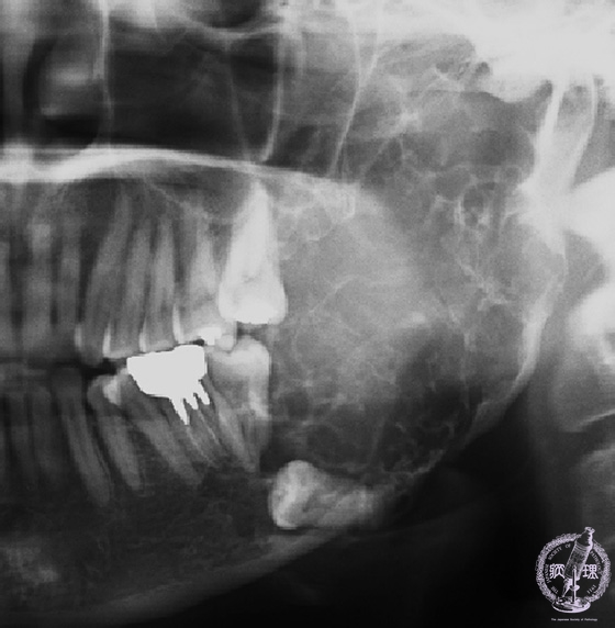 歯原性腫瘍（エナメル上皮腫）パノラマＸ線像
