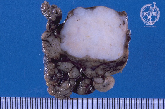 唾液腺腫瘍（多形腺腫）マクロ像