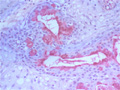 唾液腺腫瘍（粘表皮癌）ミクロ像（ムチカルミン染色強拡大）