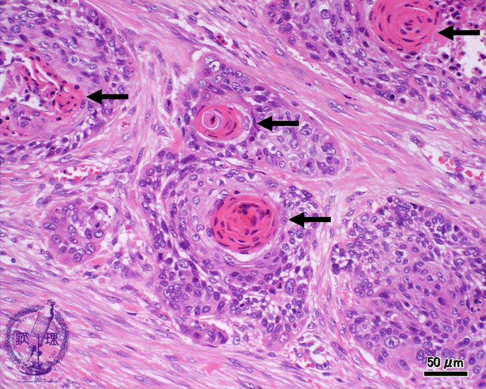 8.食道・胃 (3)食道癌（扁平上皮癌）|病理コア画像