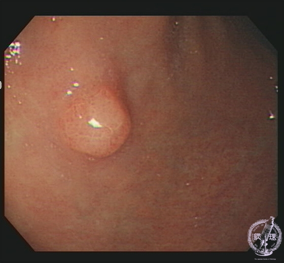 胃管状腺腫マクロ像