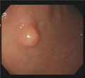 胃管状腺腫マクロ像