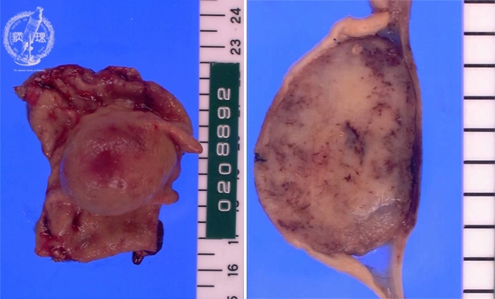 Gastrointestinal stromal tumor (GIST)マクロ像（左：粘膜面、右：割面）