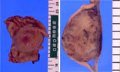 Gastrointestinal stromal tumor (GIST)マクロ像（左：粘膜面、右：割面）