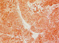 Gastrointestinal stromal tumor (GIST)ミクロ像（c-KIT免疫染色中拡大）