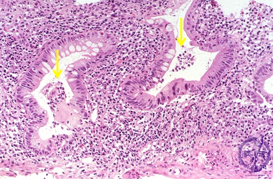  UCによる陰窩膿瘍の治療