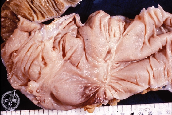 腸結核マクロ像