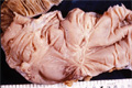 腸結核マクロ像