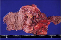 アメーバ赤痢マクロ像(手術材料）