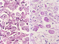 アメーバ赤痢ミクロ像（左：HE染色、右：PAS染色強拡大）