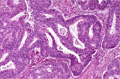 大腸癌（腺癌、腺腫内腺癌）ミクロ像（HE中拡大）