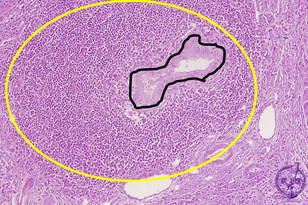 原発性胆汁性肝硬変と原発性硬化性胆管炎はどのように治療されますか?