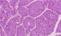 肝細胞癌ミクロ像（HE強拡大）