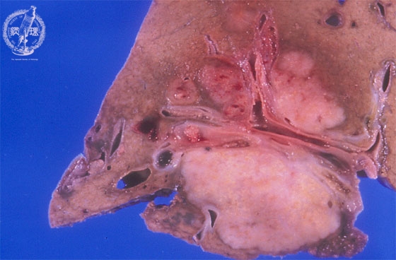 肝内胆管癌（腺癌）マクロ像