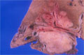 肝内胆管癌（腺癌）マクロ像