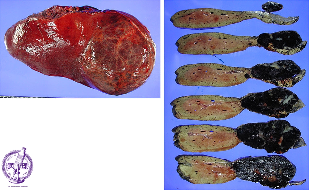 10 肝臓 14 肝血管腫 病理コア画像