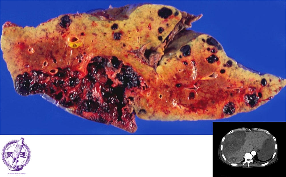 10 肝臓 14 肝血管肉腫 病理コア画像