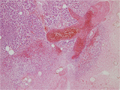 急性出血性壊死性膵炎、膵仮性嚢胞ミクロ像（弱拡大）