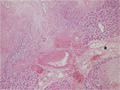 急性出血性壊死性膵炎、膵仮性嚢胞ミクロ像（HE弱拡大）