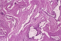 膵臓癌（膵管癌、腺癌）ミクロ像（HE弱拡大）