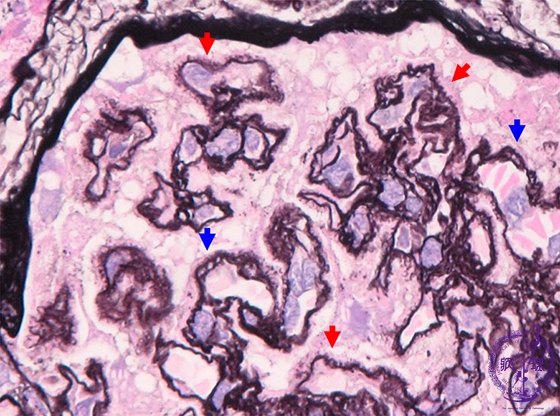 膜性腎症ミクロ像（PAM染色強拡大）