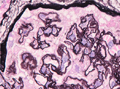 膜性腎症ミクロ像（PAM染色強拡大）