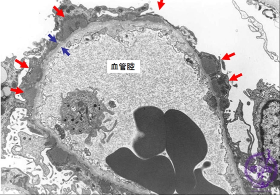 膜性腎症電子顕微鏡像： Stage �T