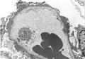 膜性腎症電子顕微鏡像電子顕微鏡像： Stage �T