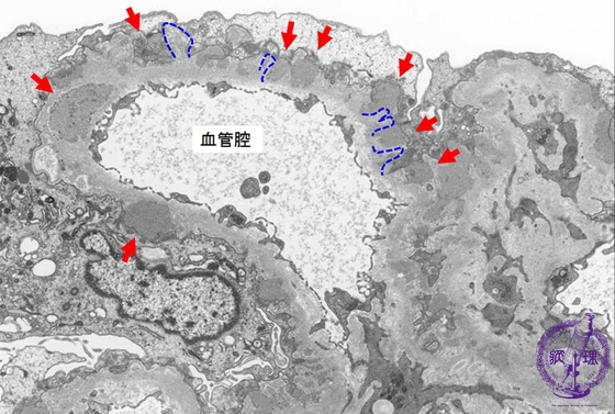 膜性腎症電子顕微鏡像：Stage �U