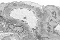 膜性腎症電子顕微鏡像：Stage �U