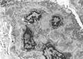 膜性腎症電子顕微鏡像：Stage �V