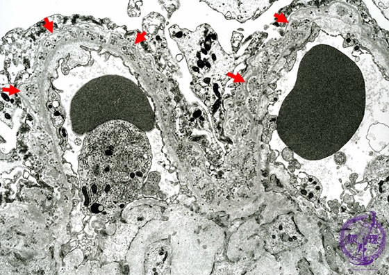 膜性腎症電子顕微鏡像：Stage �W