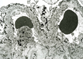 膜性腎症電子顕微鏡像：Stage �W